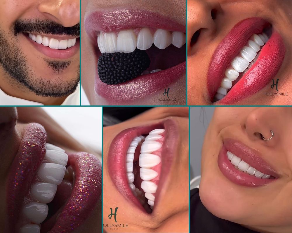 Facettes dentaires Emax 6D 1 Exemples de Sourires après Facettes Dentaires